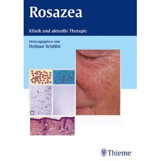 Rosazea. Klinik und aktuelle Therapie Helmut Schöfer